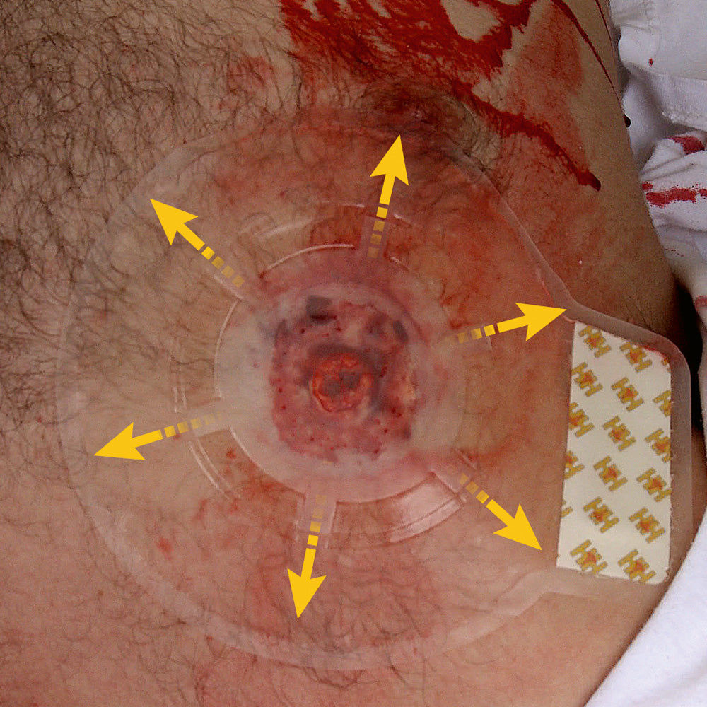 H* Vent Chest Seal, 2 Stk